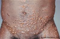 bullous_pemphigoid_2_low-jpg-jpg.jpg