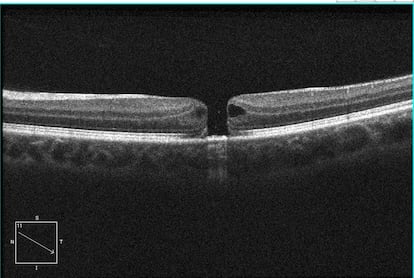 Tomografía de coherencia óptica (OCT) de la retina en el ojo izquierdo de Daniel, donde pueden verse las diferentes capas con un agujero de su espesor completo de la retina, cedida por su oftalmólogo..